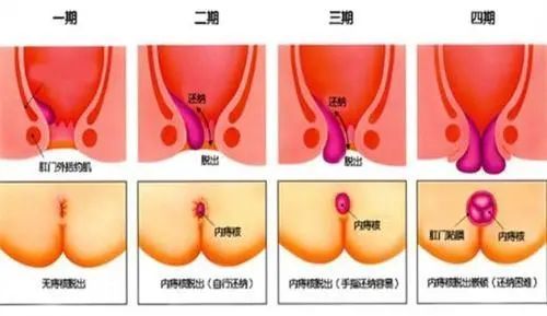 幫助治療術後水腫,並有促進傷口癒合的作用,適用於以上不同程度地痔瘡