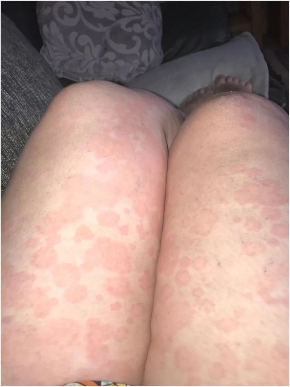 荨麻疹麻疹样皮疹算是新冠确诊患者最常见的皮肤症状,常表现为四肢