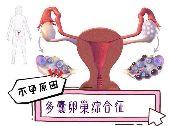 多囊卵巢不孕
