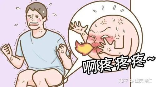 病因:靜脈曲張或皮膚破裂後感染形成.2,外痔:生長於肛管皮膚下.