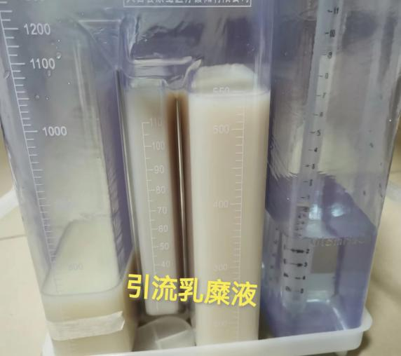 西北首例淋巴介入治疗儿童难治性乳糜胸伴骨质破坏顺利完成