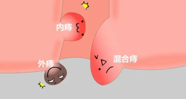 痔疮症状征兆?陈年老痔疮怎么根治?