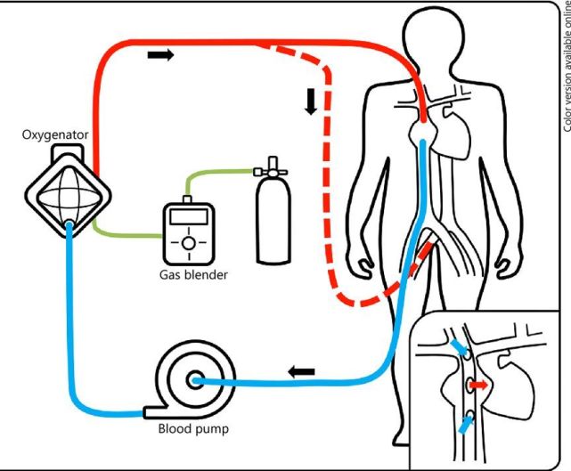 国产高性能ECMO，实现重大突破_腾讯新闻