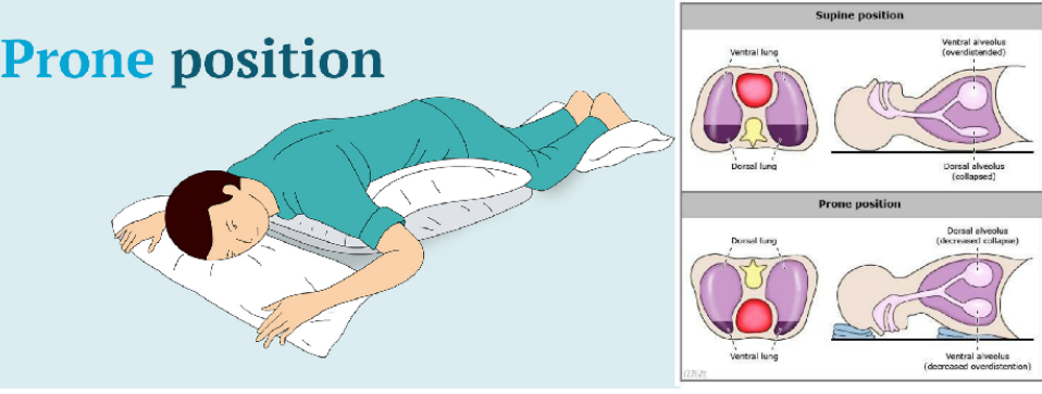 湘雅医院推行清醒俯卧位通气,助力新冠病毒感染患者改善低氧_腾讯新闻