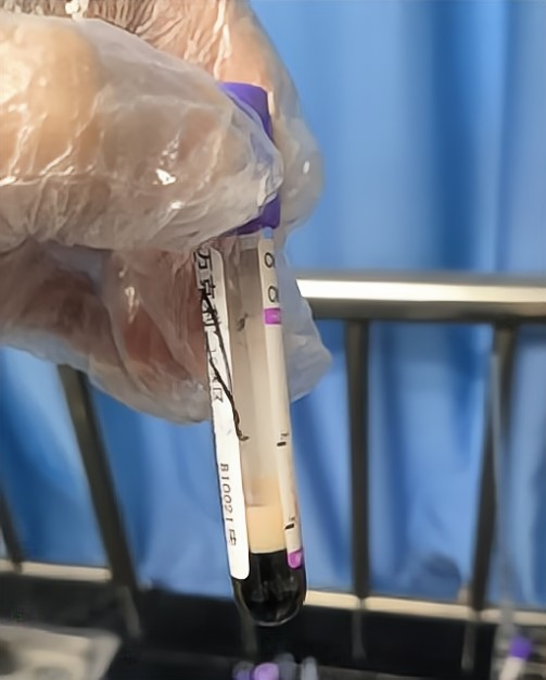 血常规遇到脂血影响检测时,该如何处理?