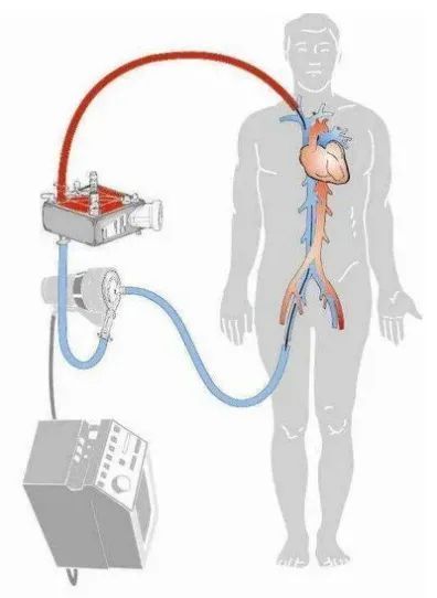 ECMO ׸ECMOƷ