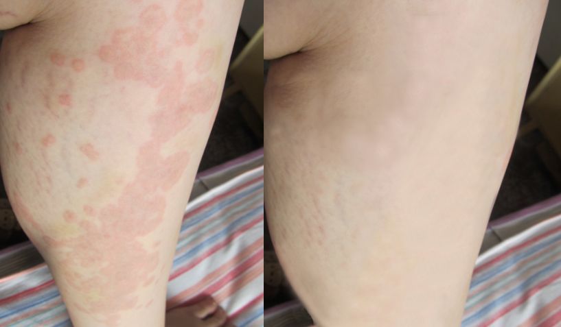 荨麻疹风团瘙痒止不住?每天早晚这样做,全身风团疙瘩说没就没!