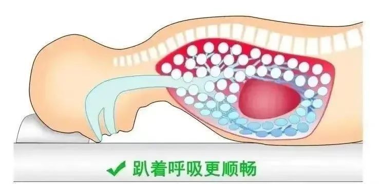 张文宏团队阳了胸闷气短怎么办俯卧位通气学起来