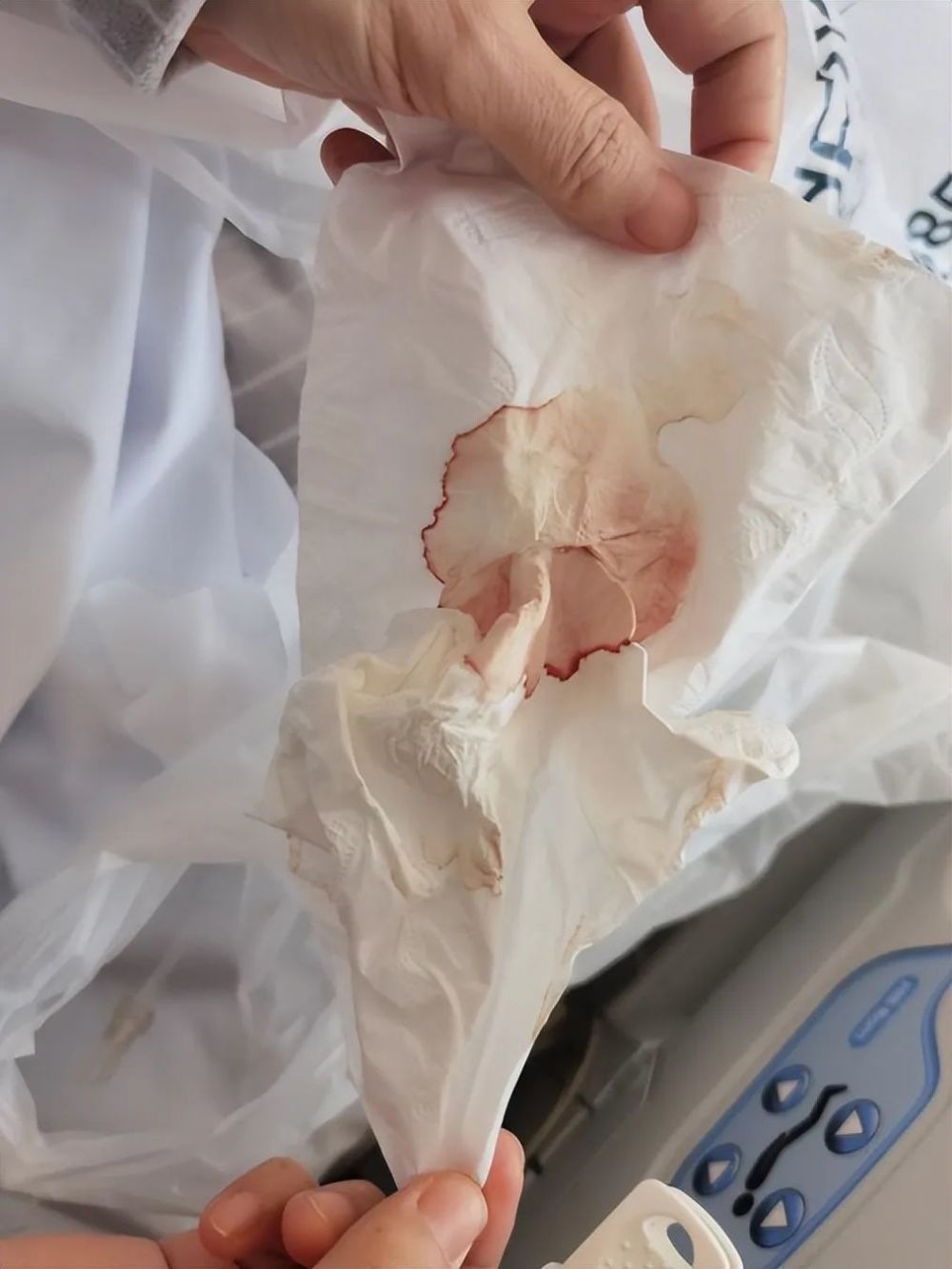 阳后咳到大口吐血男子一个细节让医生警惕起来这种症状要高度重视
