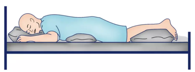 俯卧位为最佳缓解姿势,俯卧位困难者可采取侧卧位.