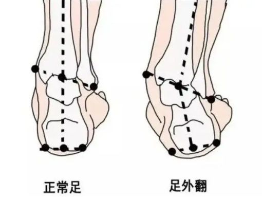 可以让孩子脱掉袜子平视观察足后跟,足外翻最明显的特征是足内侧与