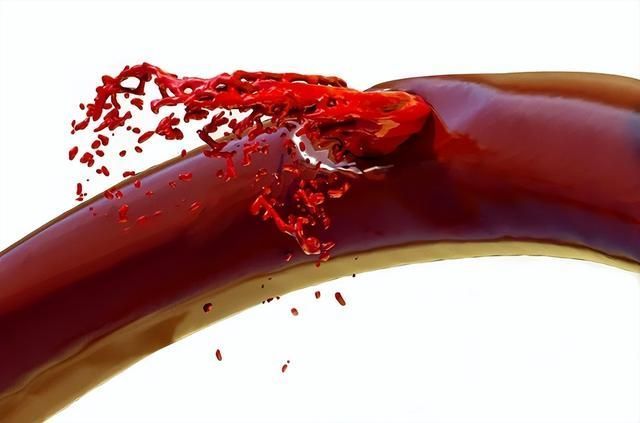 壁发生玻璃样变从而导致血管壁薄弱,当血压骤然升高时(比如酗酒,生气