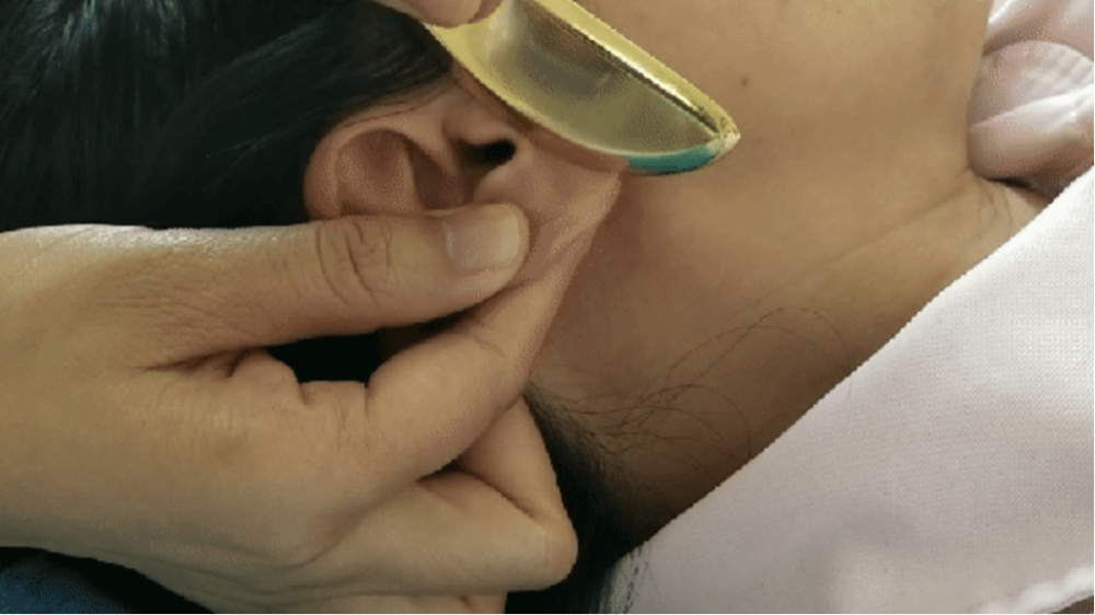 二,耳部全息铜砭刮痧:—贰—治疗病后的头晕,头痛,全身酸痛,气短乏力