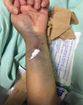 动静脉穿刺后皮下血肿怎么办这样处理效果真不错