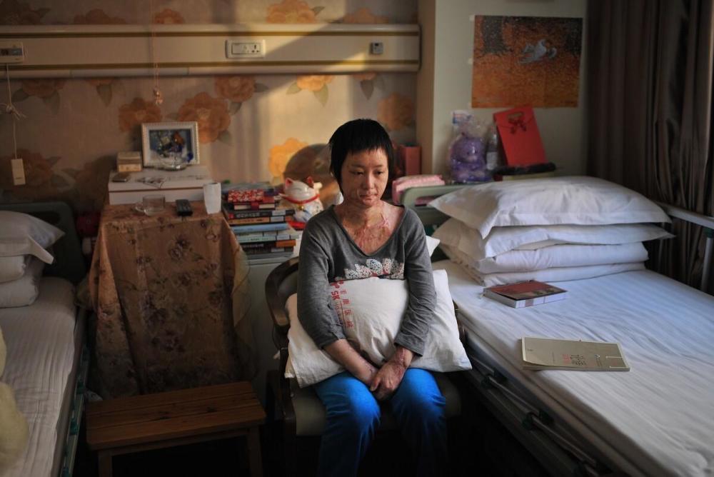 11年过去了,拒绝同学求爱,被泼汽油毁容的周岩,过得还好吗?_腾讯新闻