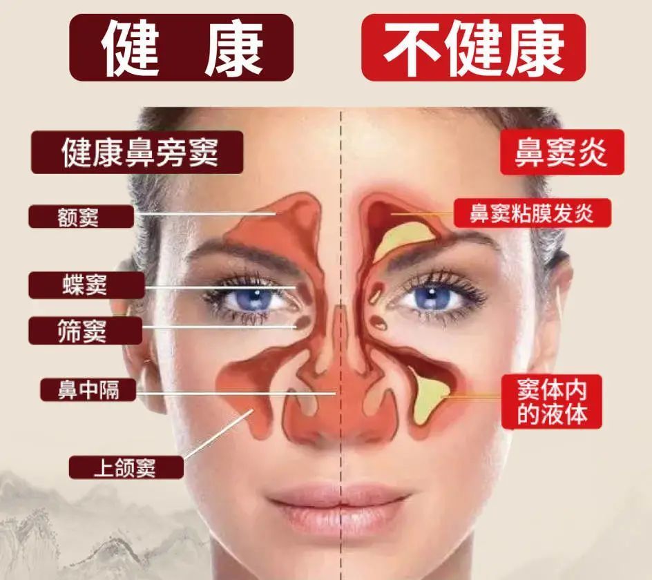 鼻窦炎忽略治疗会造成难检测的颅内并发症,脑膜炎,神经性头痛,脓肿