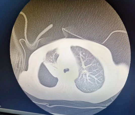一例支气管肺炎患儿并发液气胸的案例分享