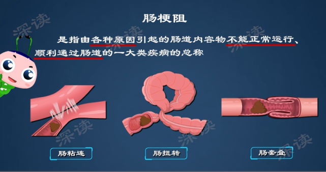 腹痛难忍拉不出屎大爷饮食不规律突发肠梗阻这些症状要小心