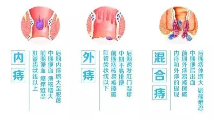 痔疮怎么引起的啊 腾讯网