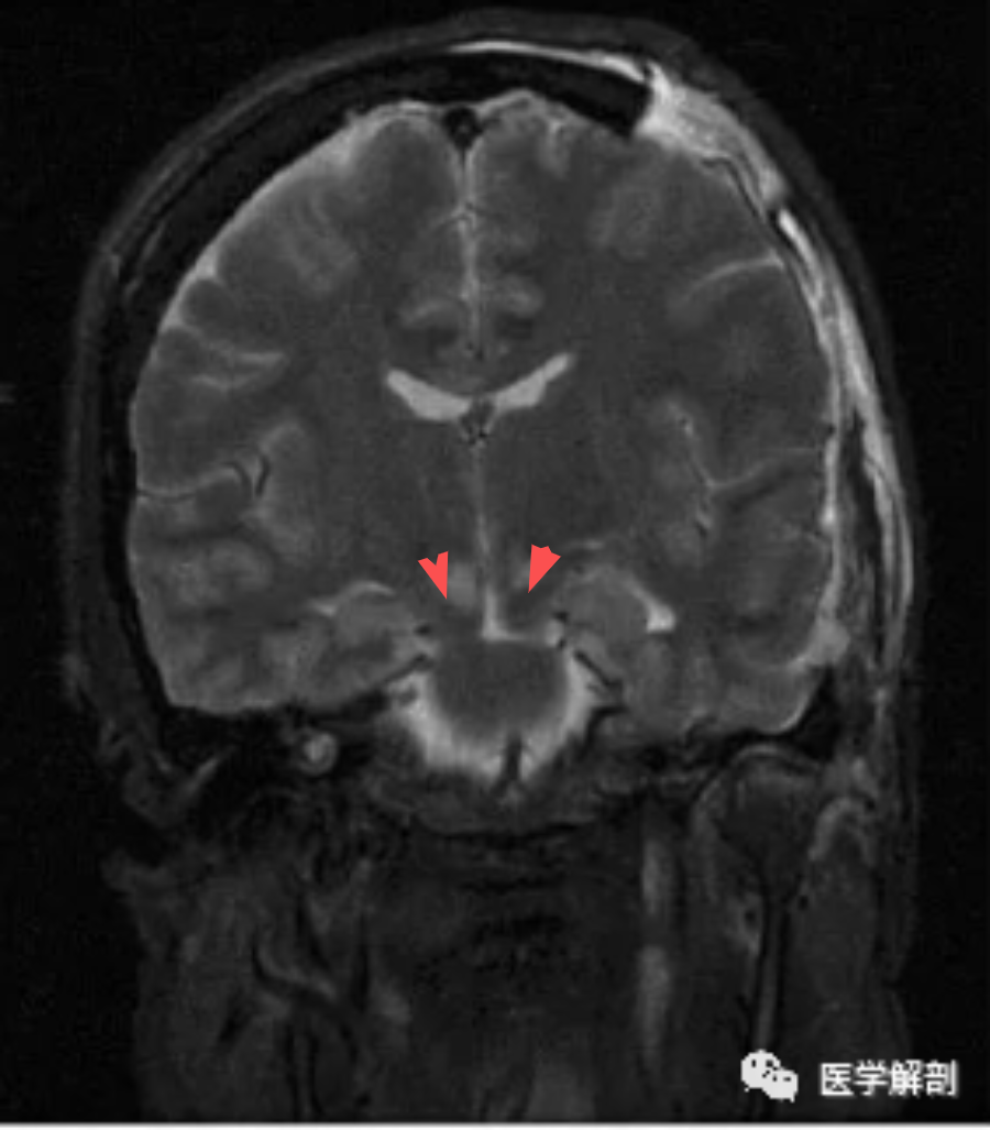 顱腦mri t2 flair 軸位示,由於腫瘤的佔位效應,同側鉤突(綠箭)突出於