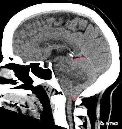 或下行性(額葉病變)導致的額葉眶回經蝶骨嵴疝入中顱窩或顳葉前部經蝶