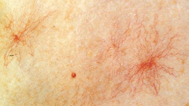 手背上的痣不是胎记是母亲带给我的乙肝印记