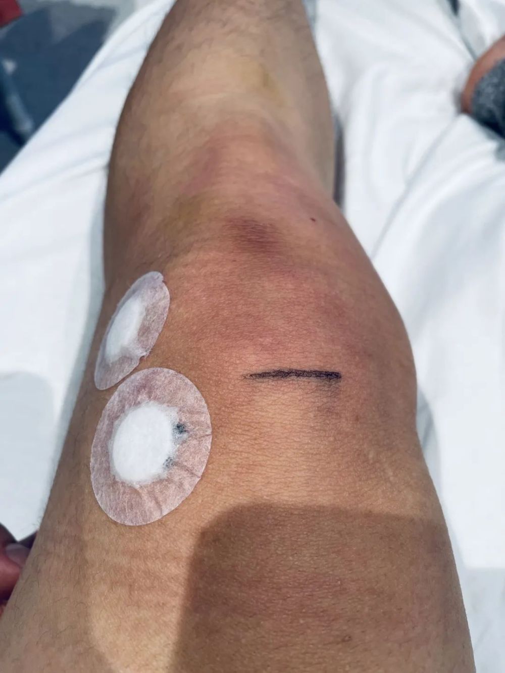 香港姑娘冲我柔柔一笑,狠狠一针戳进了我的膝盖,抽完大概30毫升积液