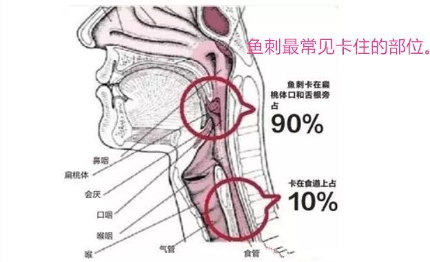 被鱼刺卡住了怎么办？知道了一根鱼刺的致命旅途，你就明白了！_腾讯新闻