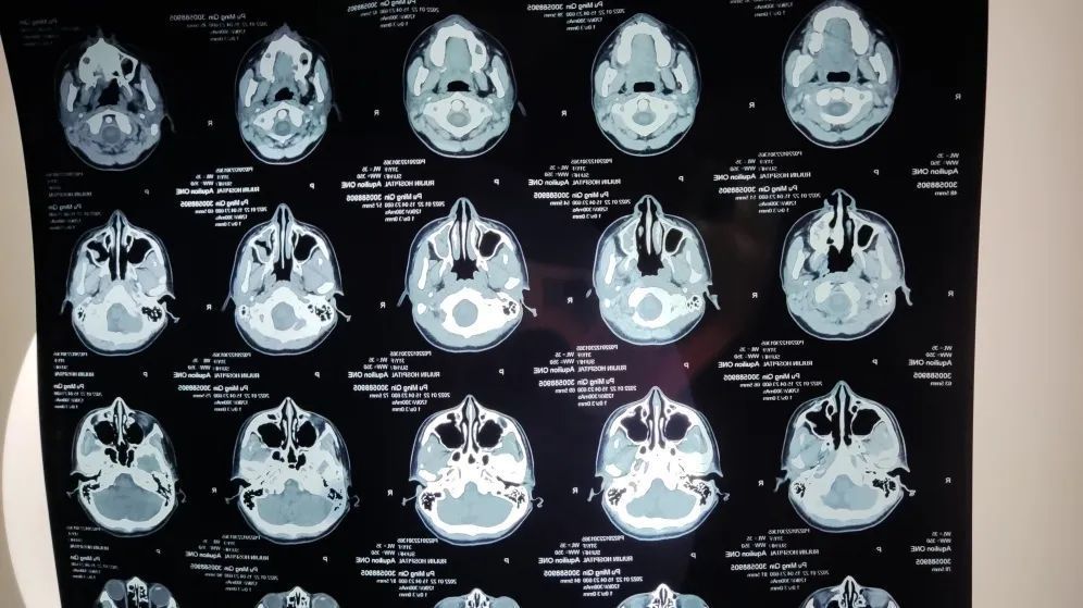 我又做了一次鼻竇ct,醫生看著結果,做出了鼻竇炎的診斷,建議做手術.