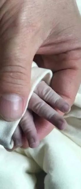 原来是两根大血管长反了新生儿口唇及四肢紫绀#幸好,福建医科大学附属