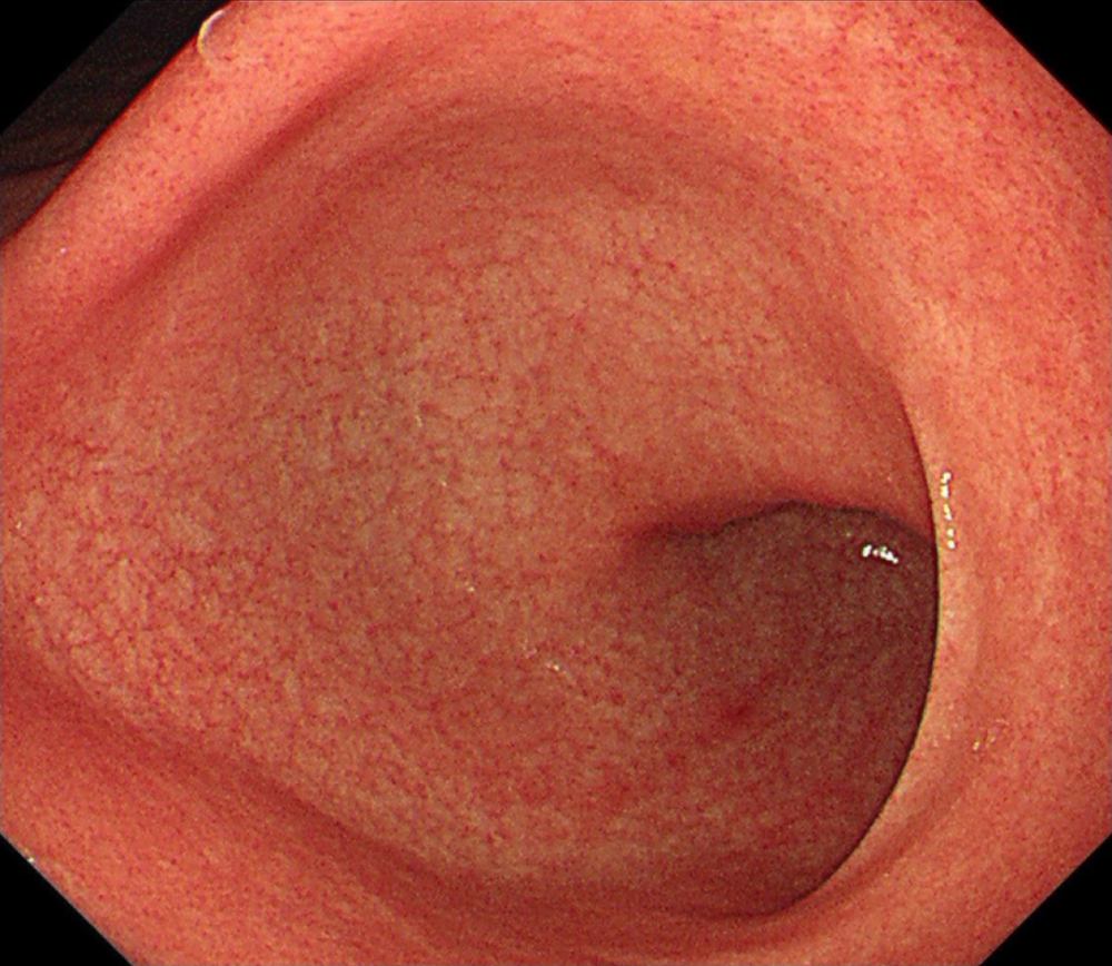 真实胃镜揭秘全过程