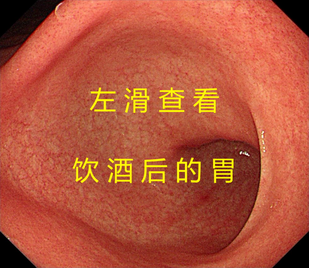 真实胃镜揭秘全过程