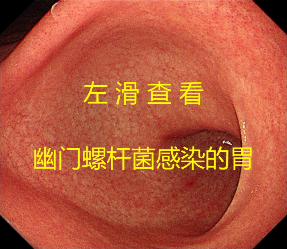 有时候给幽门螺杆菌感染者进行胃镜检查,就能看到这样典