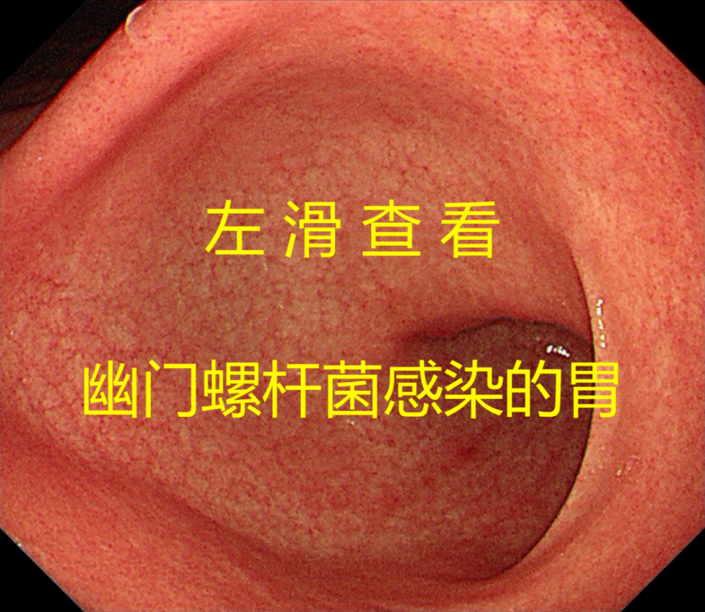 胃糜烂胃镜图片大全图片