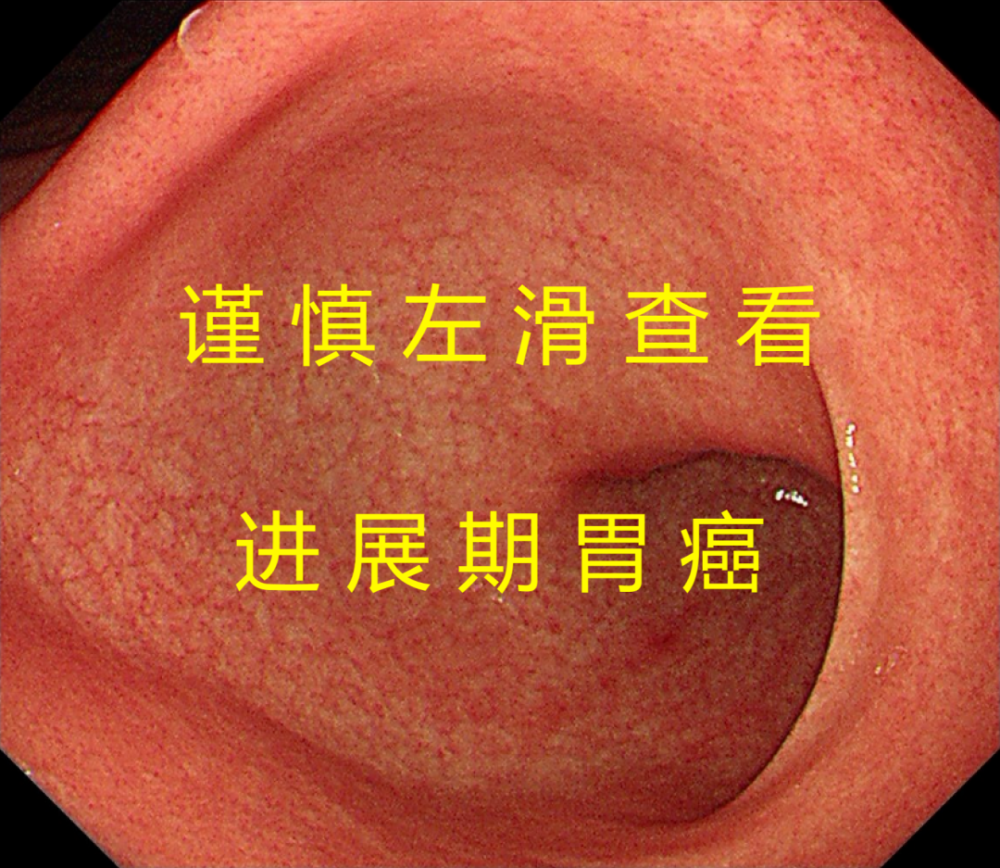 同时也不要忽略了胃镜检查筛查胃癌,及时发现胃癌端倪预防治疗处理