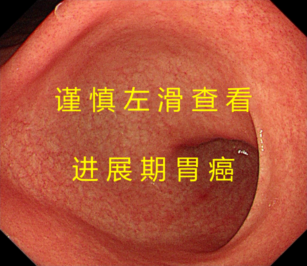 胃体正常胃镜图片图片