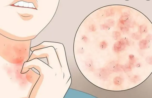 长沙鸿业皮肤病专科医院:治疗春季花粉过敏怎么样?_腾讯新闻