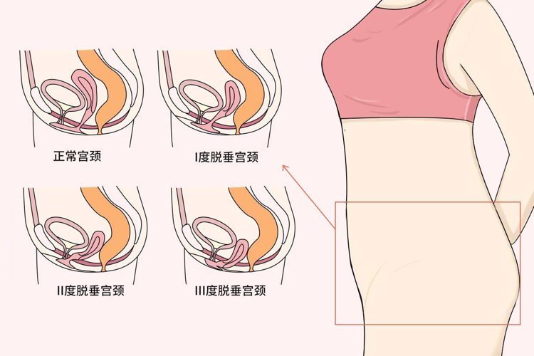 什麼是陰挺嚴不嚴重哪些女性容易患上這種病該怎麼治療