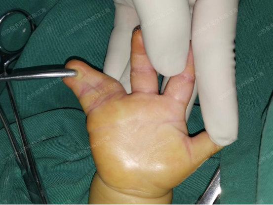 环,小指的并指,应尽早手术孩子的环指和小指并在一起,连手指甲都紧紧