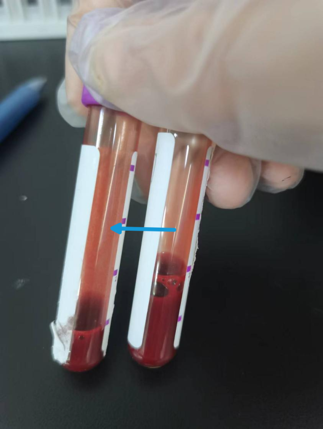 天冷了,抱团取暖的红细胞们——冷凝集