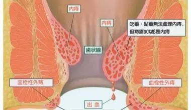 痔瘡外痔的肉球怎麼消除?試試這幾個方法,決不讓你失望!_騰訊新聞