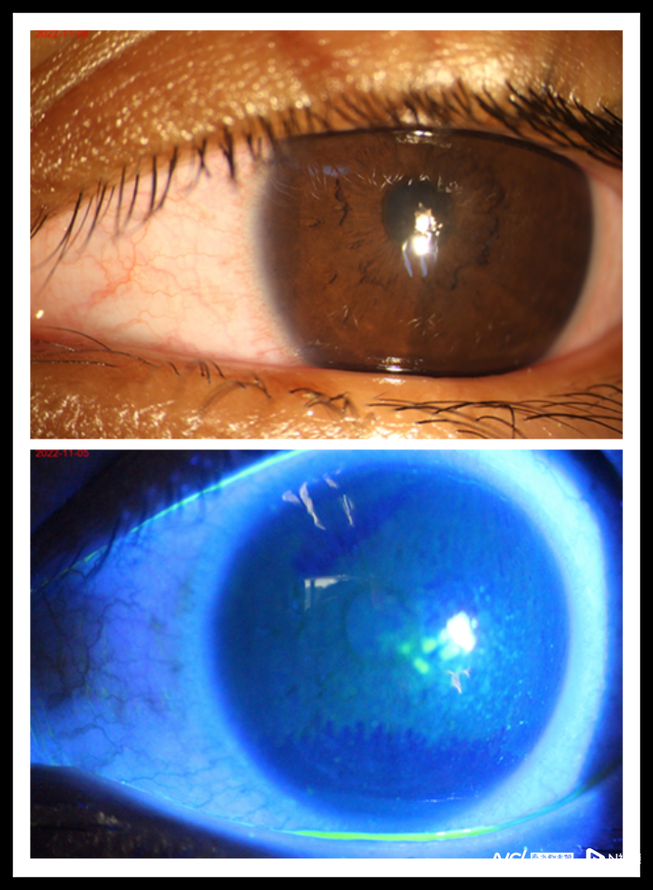 眼前段照片:结膜充血,瞳孔区局部点状着染明显共聚焦显微镜检查情况在