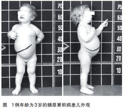 警惕糖原贮积症-腾讯新闻