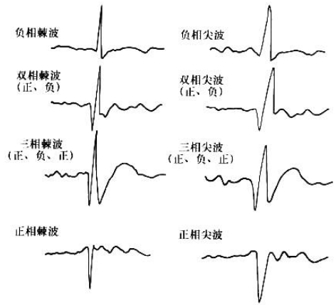 脑电图各种波形及读法图片