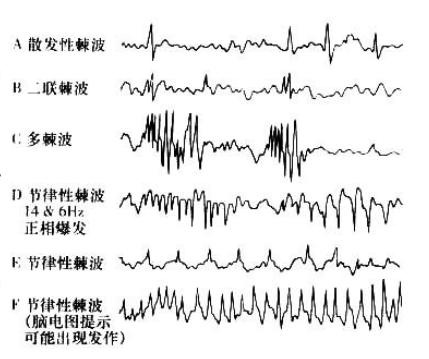 神经电生理检查：脑电图与脑磁图_腾讯新闻