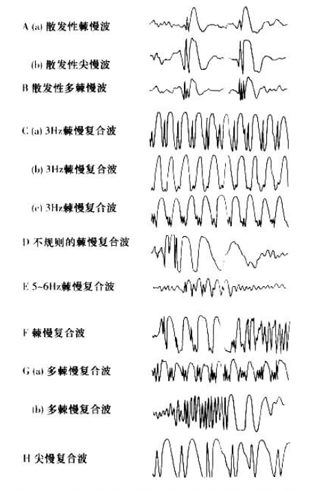 脑电图异常波解读图片