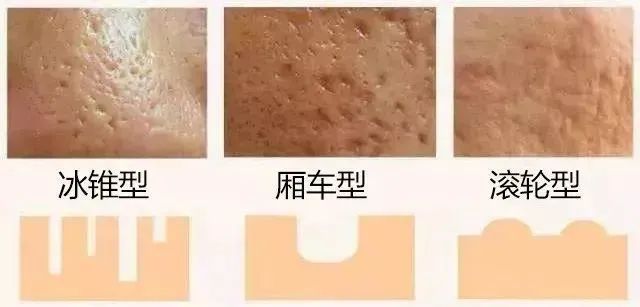不同形态或深浅的痘坑,想用激光治疗,该怎么选?