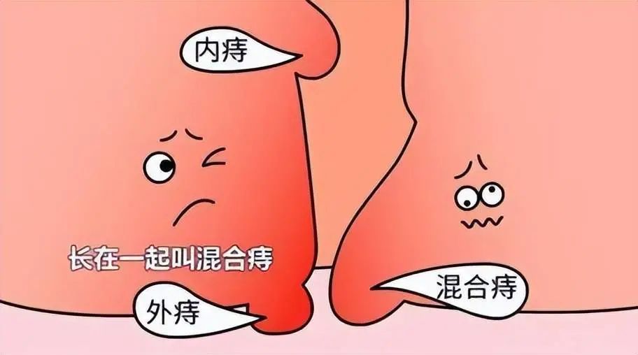 痔瘡長什麼樣子?痔瘡有哪些症狀?_騰訊新聞