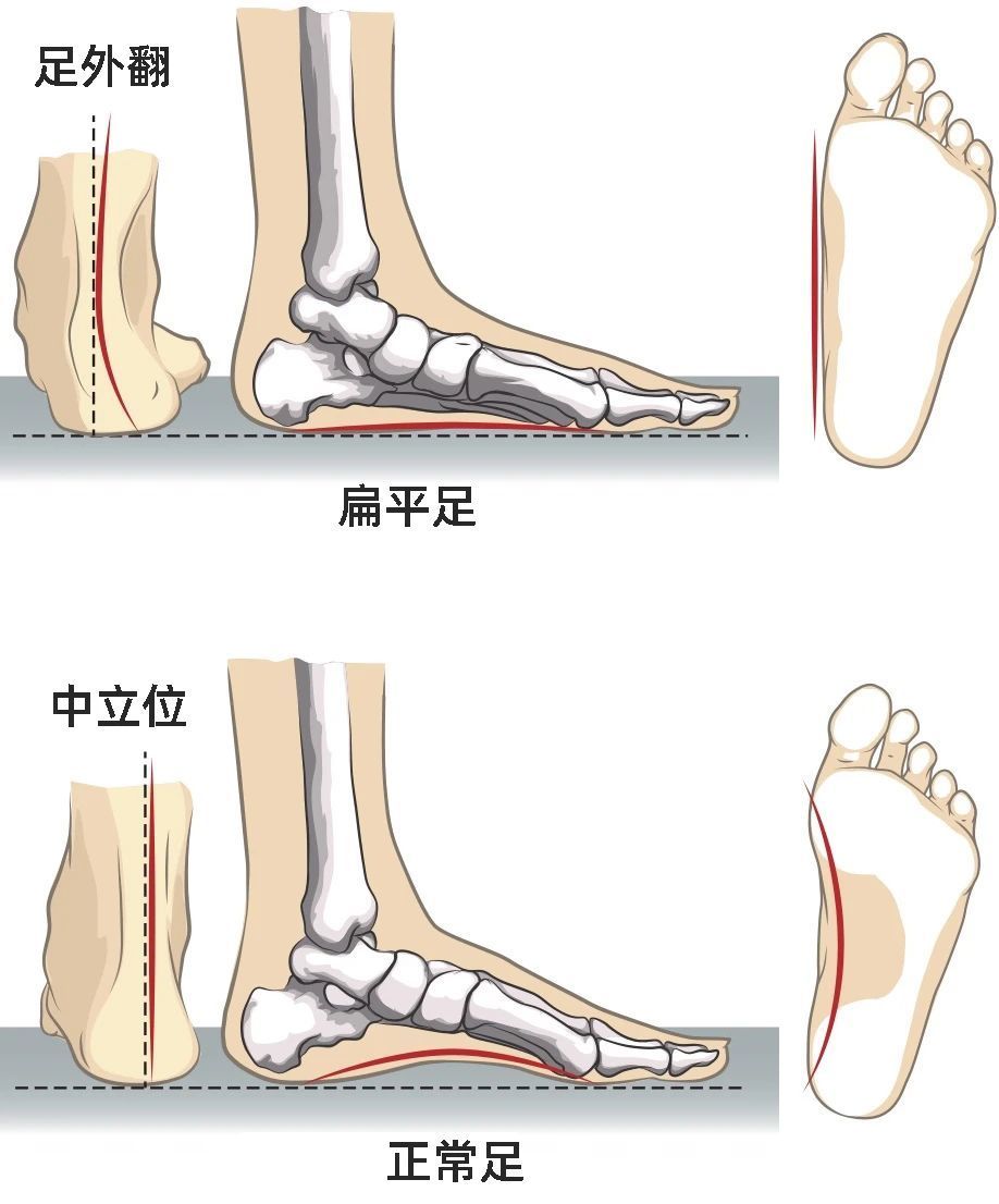 结构性扁平足,因为骨骼畸形,脚底本身缺乏足弓支撑,使得脚底韧带被