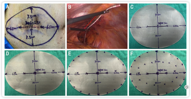 疝补片修补术图片
